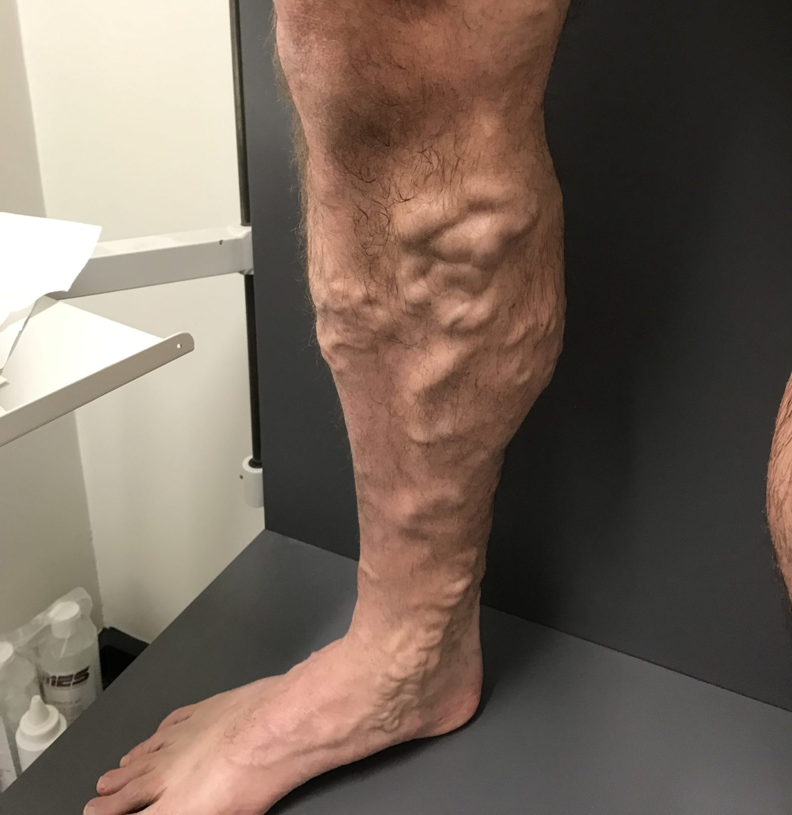 Severe Varicose Vein Melbourne Varicose Vein