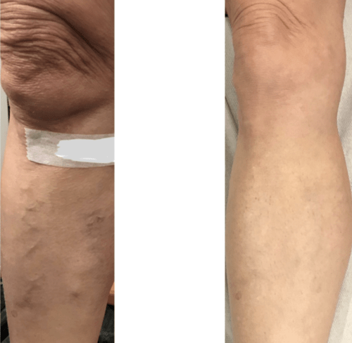 Treating surface varicose veins with expert care