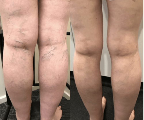 Treating spider veins & reticular veins by a multifaceted treatment