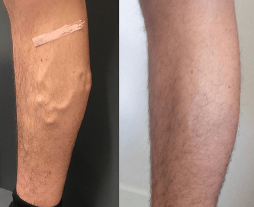 Treating bulging varicose veins on medial and posterior parts of right leg