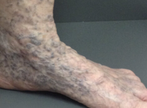 Abnormal Veins In The Feet And Ankle - Veins Treatment