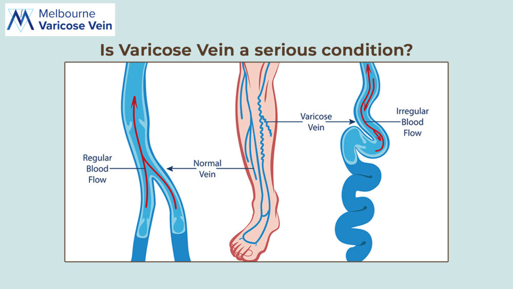Is Varicose Vein a Serious Condition| MVV