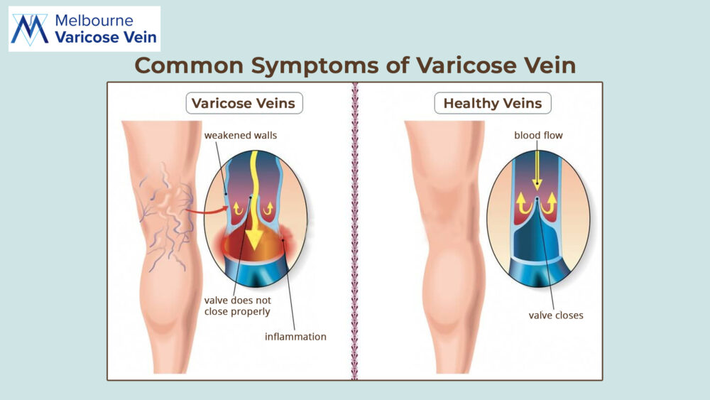 Common Symptoms of Varicose Vein| MVV