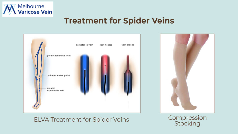 Spider Vein Treatment |MVV