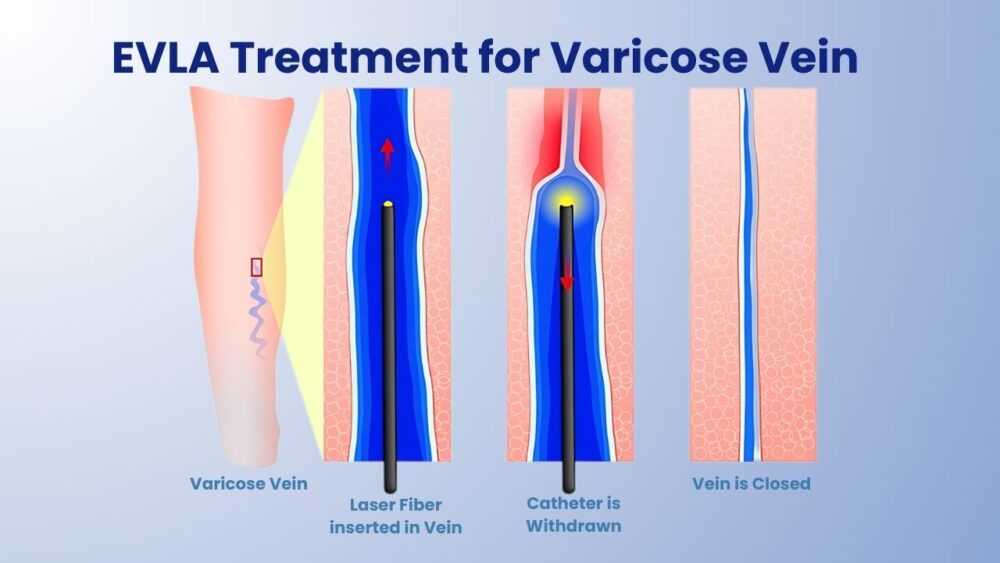 EVLA-Treatment-for-Varicose-Vein