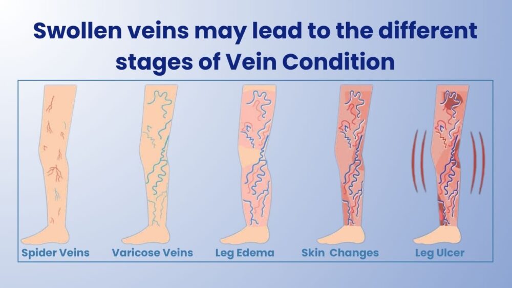 Stages of Vein Condition