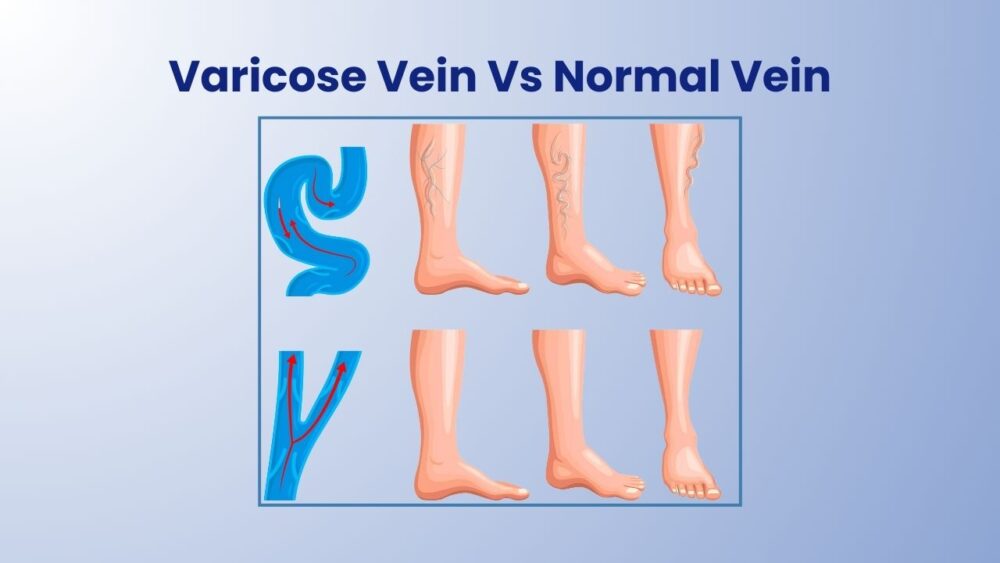 How to Get Rid of Discomforting Varicose Veins? - Best Vein Varicose Clinic in Victoria Melbourne