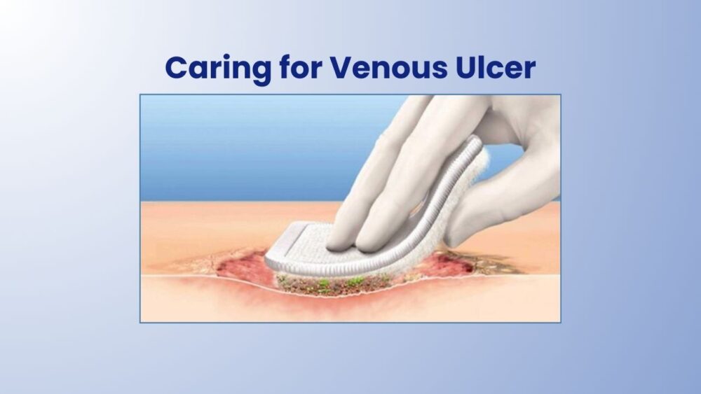 Caring for Venous Ulcer