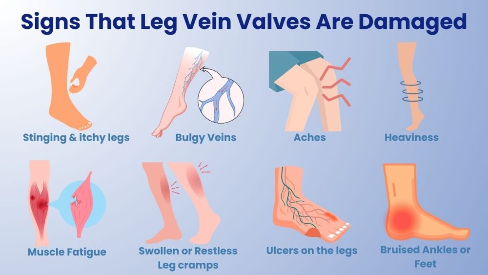 Signs That My Vein Valves Are Damaged