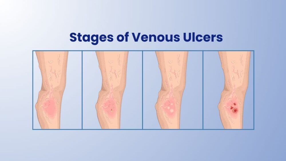 Venous Leg Ulcer: Causes, Symptoms & Its Treatment - Best Vein Varicose Clinic in Victoria Melbourne