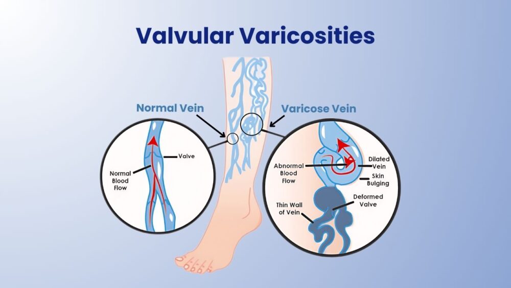 Varicosities Veins: Causes, Symptoms, & Its Treatment - Best Vein Varicose Clinic in Victoria Melbourne