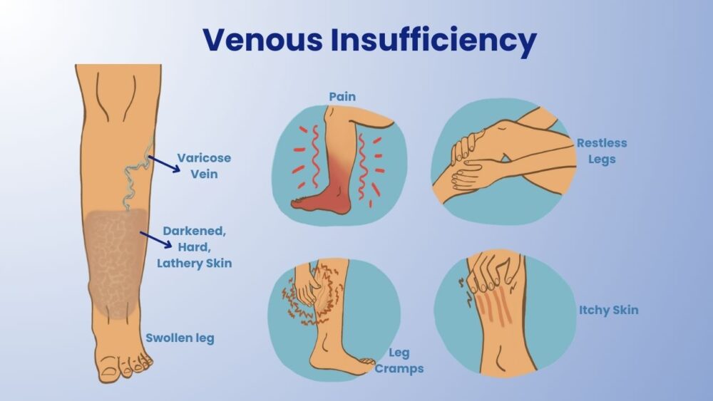 Venous Insufficiency: Symptoms, Causes, Risk factors, Types & Treatments - Best Vein Varicose Clinic in Victoria Melbourne