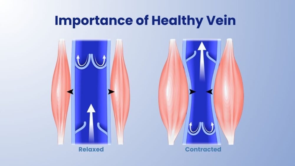 Importance of Healthy veins - Best Vein Varicose Clinic in Victoria Melbourne