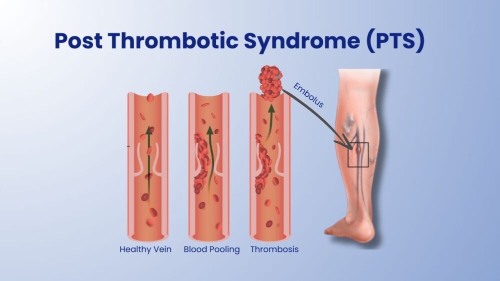 Post Thrombotic Syndrome - Best Vein Varicose Clinic in Victoria Melbourne