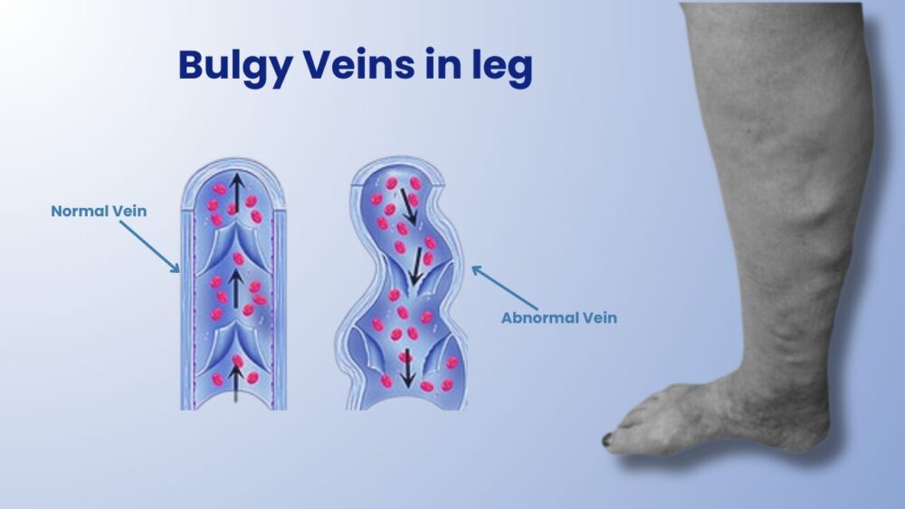 Want to Deal with Bulgy Veins in Leg? - Best Vein Varicose Clinic in Victoria Melbourne