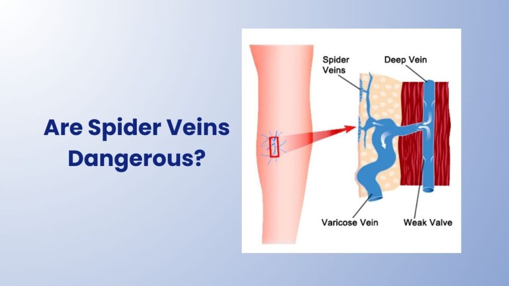 Are Spider Veins Dangerous? - Best Vein Varicose Clinic in Victoria Melbourne