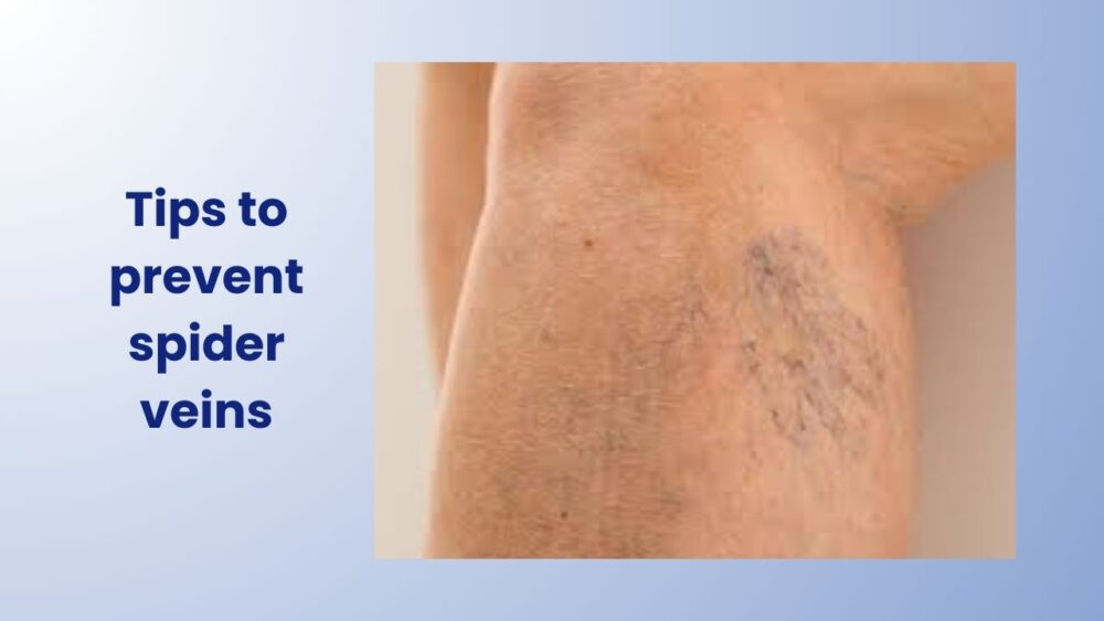 Tips to Prevent Spider Veins - Best Vein Varicose Clinic in Victoria Melbourne