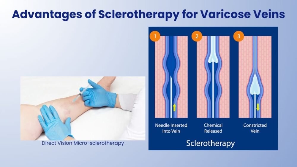 Sclerotherapy: Varicose Veins Treatment - Best Vein Varicose Clinic in Victoria Melbourne