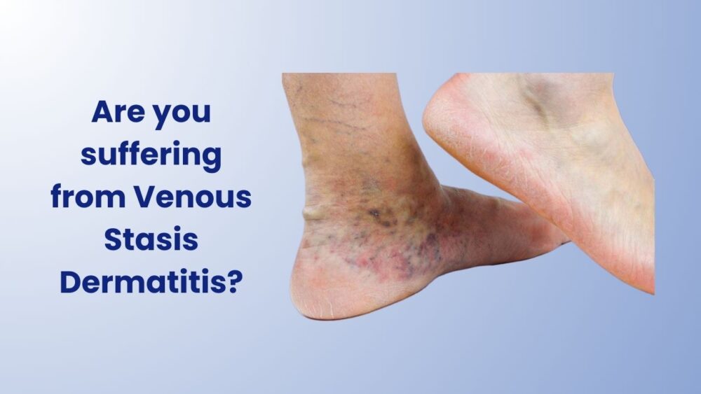 Are You Suffering from Venous Statis Dermatitis? - Best Vein Varicose Clinic in Victoria Melbourne