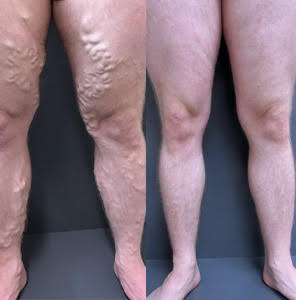 Treating bulgy varicose veins and its painful symptoms by ELVA & UGS