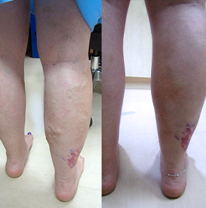 Treating varicose vein in right calf by EVLA UGS & DVS