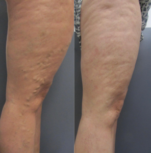Treating bulgy veins on the front and outer part of right leg - Best Vein Varicose Clinic in Victoria Melbourne