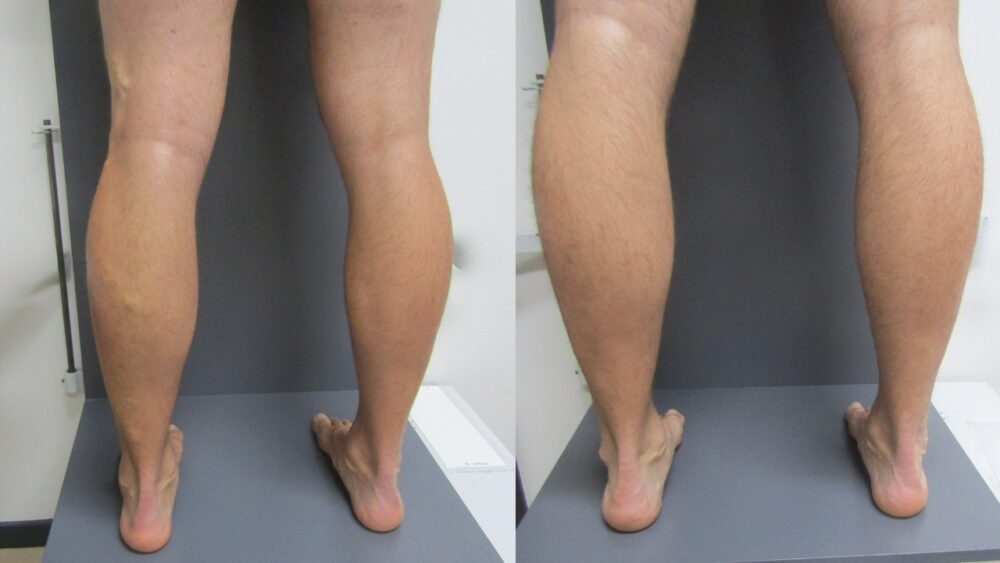 Overcoming Varicose Veins Through Modern Treatments