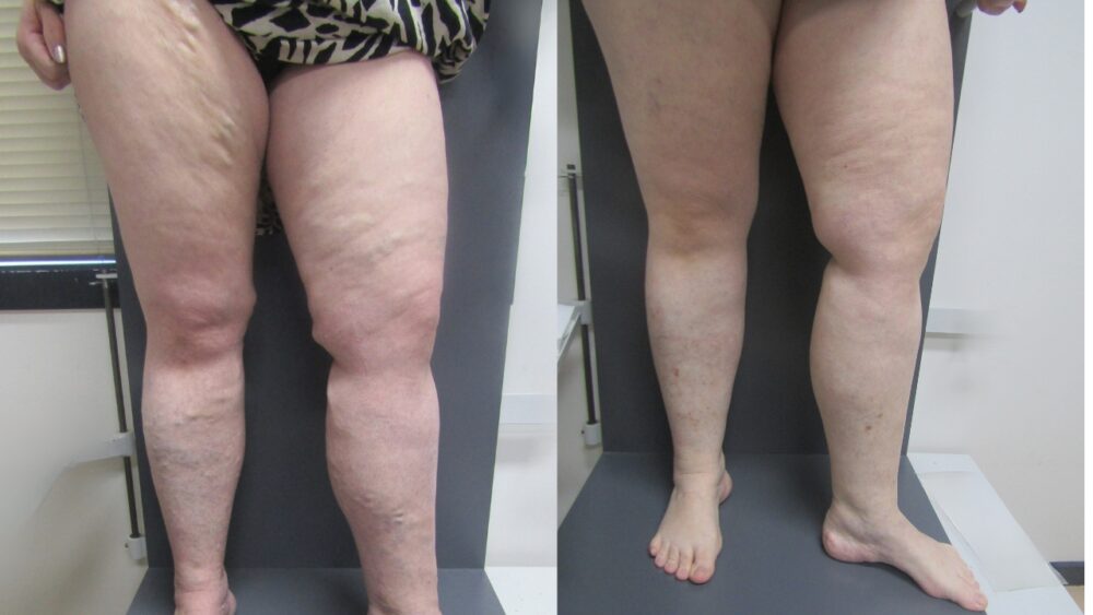 Modern Approaches to Varicose Vein Treatment - Best Vein Varicose Clinic in Victoria Melbourne