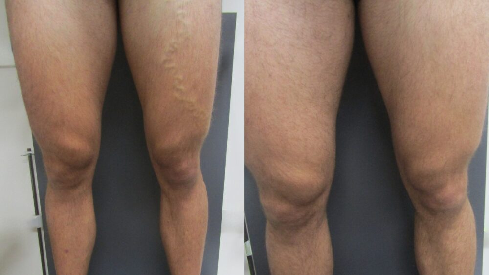 Treating Varicose Veins With Endovenous Laser Ablation (EVLA)